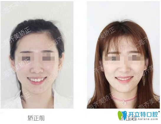 袁峰牙齒矯正前后對比案例