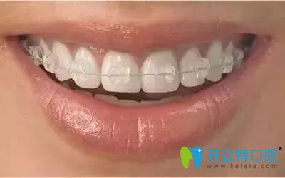 南京雅康半隱形陶瓷矯正 南京雅康半隱形陶瓷矯正