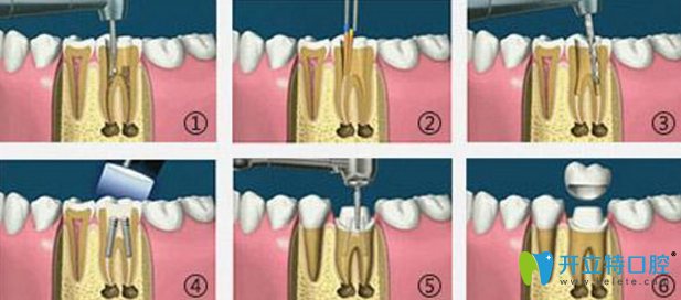 東莞美立方全瓷牙過程