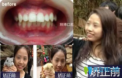 無錫拜博口腔陳炳霖做牙齒矯正美白前照片