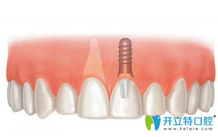 南通牙博士口腔種植牙 南通牙博士口腔種植牙