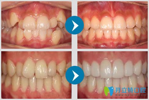 南京雅康隱形矯正真人案例 南京雅康隱形矯正真人案例