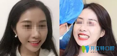 無錫拜博口腔牙齒矯正一年效果圖