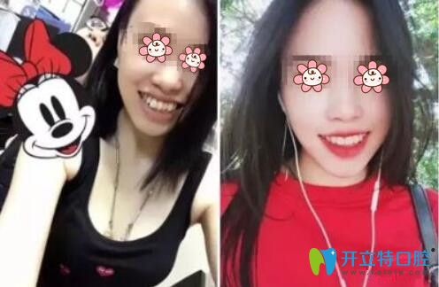 張拓院長牙齒矯正案例 張拓院長牙齒矯正案例