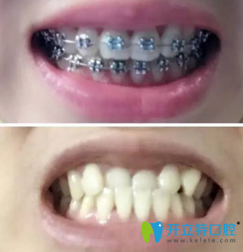 剛帶上牙套的樣子