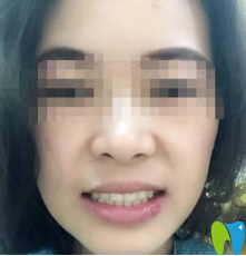 牙齒完全恢復(fù)好的樣子