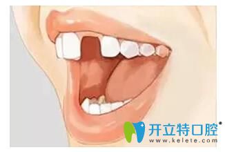 如果缺少了一顆牙 是選擇種植牙好還是烤瓷牙好呢？