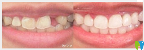 寧波牙博士口腔王道軍院長種植牙案例效果圖