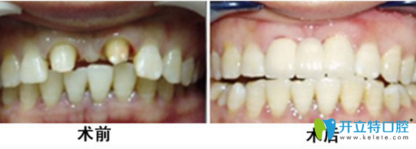 唐琛琛醫(yī)生牙齒種植修復(fù)真人案例