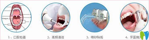 揚洲菲特口腔超聲波潔牙過程 揚洲菲特口腔超聲波潔牙過程