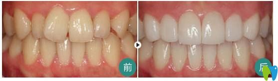 費(fèi)麗敏主任牙齒不齊矯正案例