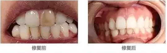 我們的牙齒為什么這么黃？新鄉(xiāng)貝特口腔教你來(lái)變白