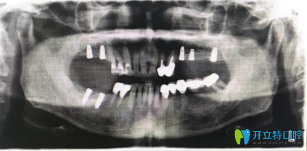 種植后全景片 種植后全景片
