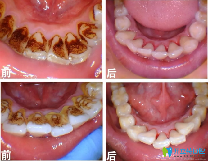 超聲波潔牙對(duì)比案例