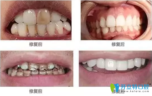 牙貼面對(duì)比案例