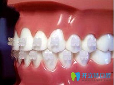 舟山健寧半透明陶瓷矯正器