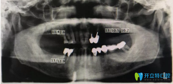 下為術前X光片 下為術前X光片