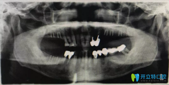 術前擬植入位點設計 術前擬植入位點設計