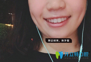 經(jīng)過1年1個月時間牙齒矯正整齊