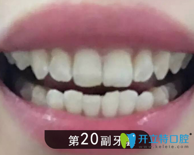 矯正1年后牙齒明顯整齊