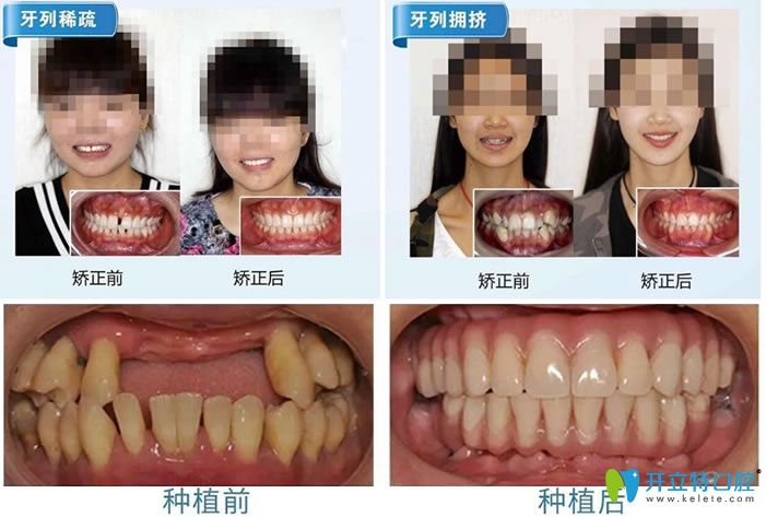 南京丹德齒科種植牙和牙齒矯正案例 南京丹德齒科種植牙和牙齒矯正案例