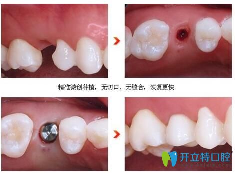 宿遷大眾口腔微創(chuàng)種植牙 安心種植新選擇！