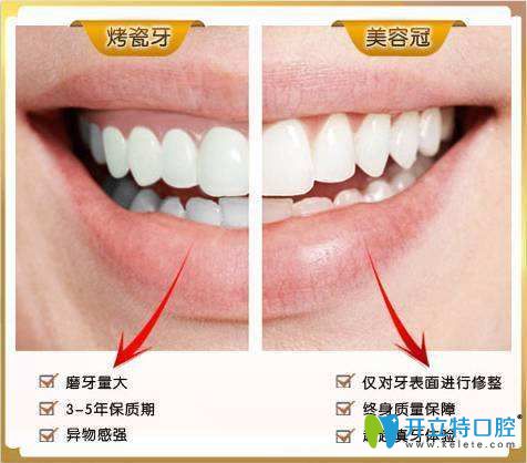 仿生美容冠和烤瓷牙對(duì)比