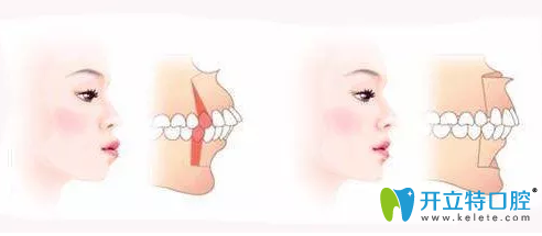 齙牙的情況 齙牙的情況