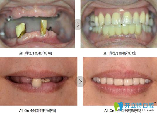 鎮(zhèn)江拜博口腔院長萬書健全口牙種植案例前后對比圖