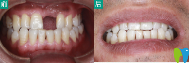 石家莊三博口腔種植牙案例 石家莊三博口腔種植牙案例