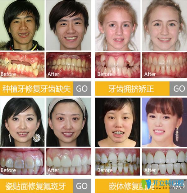 呼市亞非口腔治療真人案例