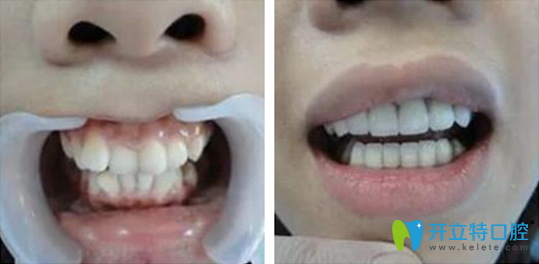 任國亨主任牙齒矯正案例