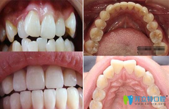 呼市亞非口腔蘇世平牙齒矯正案例 呼市亞非口腔蘇世平牙齒矯正案例