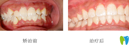 拜博拜爾口腔周茂棟院長(zhǎng)牙齒正畸效果對(duì)比圖