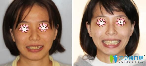 羅陽(yáng)醫(yī)師牙齒修復(fù)案例