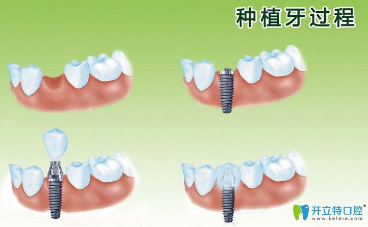 衡水口腔解答：?jiǎn)晤w牙種植后會(huì)出現(xiàn)松動(dòng)嗎