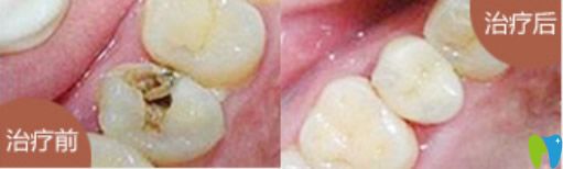 小白兔口腔兒童齲齒治療效果 小白兔口腔兒童齲齒治療效果