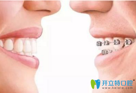 兒童用隱形牙套和傳統(tǒng)牙套哪個(gè)效果好？