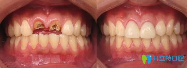 于嘉琳前牙齲齒全瓷牙修復案例