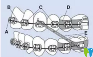 徐州博愛口腔牙齒矯正示意圖 徐州博愛口腔牙齒矯正示意圖