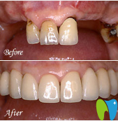 廣州暨博口腔潘廣嗣上半口牙幾乎全部缺失種植案例: 廣州暨博口腔潘廣嗣上半口牙幾乎全部缺失種植案例: