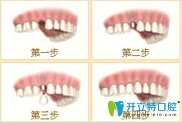 拜博拜爾口腔種植牙介紹