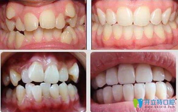 晉中潤芽口腔牙齒擁擠矯正前后對比照