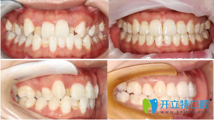 這是我手術(shù)前和手術(shù)后的牙齒照片對比圖