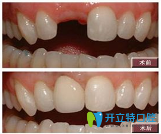 拜博拜爾口腔種植牙效果圖