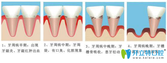 牙周炎的過(guò)程 牙周炎的過(guò)程