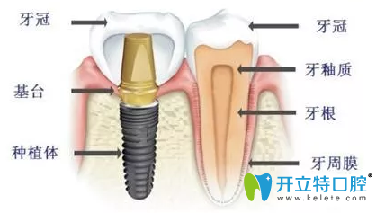 洛陽維樂口腔門診部種植牙示意圖 洛陽維樂口腔門診部種植牙示意圖