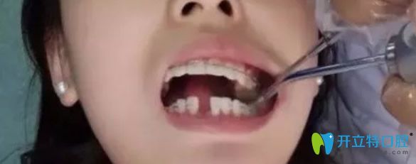 孝感口腔牙齒矯正前圖片