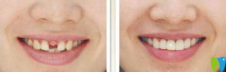 廈門宏沅膛口腔許保春種植牙效果對(duì)比圖 廈門宏沅膛口腔許保春種植牙效果對(duì)比圖