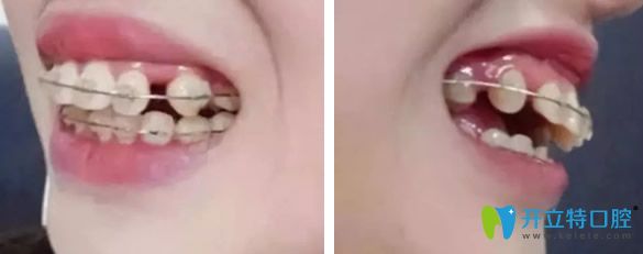 孝感口腔骨源性齙牙矯正方法